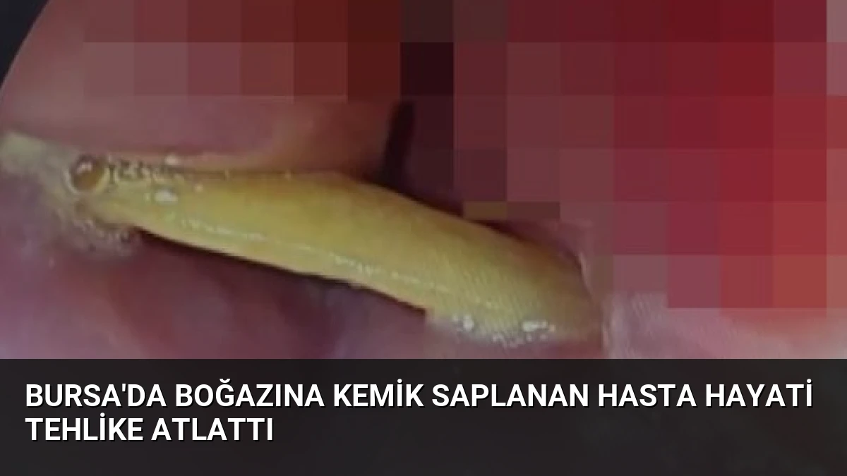 Bursa’da Boğazına Kemik Saplanan Hasta Hayati Tehlike Atlattı