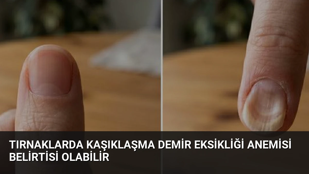 Tırnaklarda Kaşıklaşma Demir Eksikliği Anemisi Belirtisi Olabilir